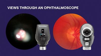 Direct Ophthalmoscope View