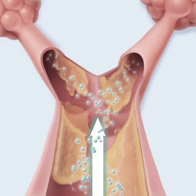 Lung Expansion CPEP image 3