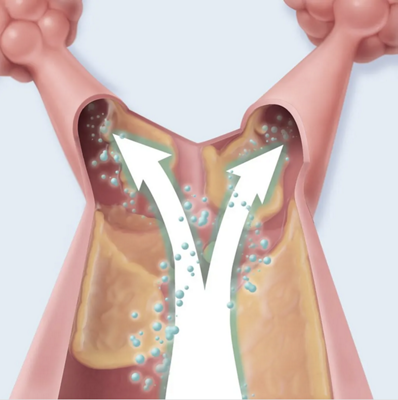 Lung Expansion CPEP image 4