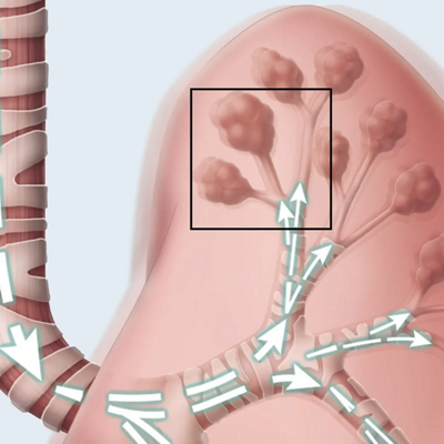 Lung Mobilization CHFO image of secretions loosened