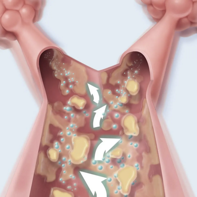 Lung Mobilization CHFO continuous high frequency oscillation