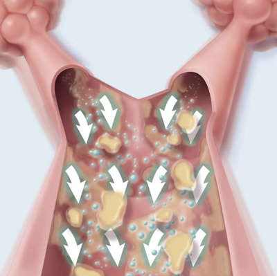 Lung Mobilization CHFO image accelerated expiratory airflow