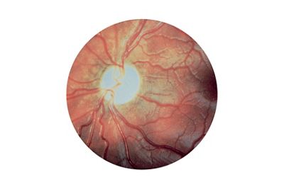 Optic Atropy fundus image