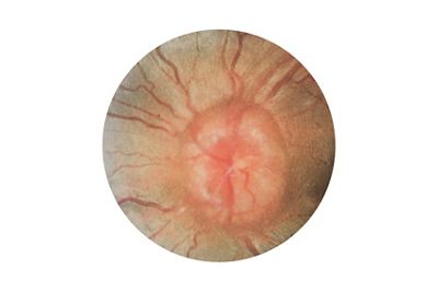 Papilledema fundus image