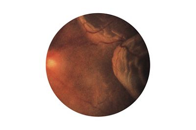 Retinal Tear fundus image